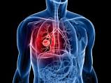 Lung cancer